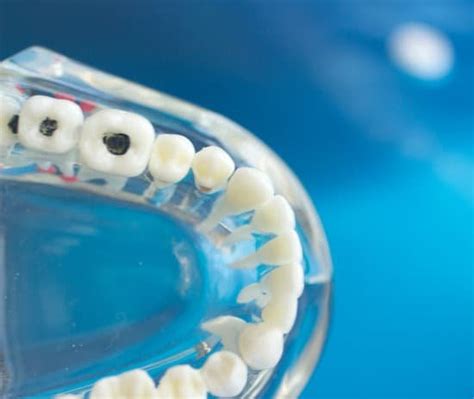 What Do Dry Sockets Feel Like Wisdom Teeth T Tapp