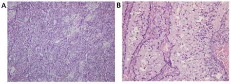 Primary Ovarian Signet Ring Cell Carcinoma A Rare Case Report