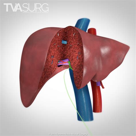 Donor Right Hepatectomy Pkvisualization Surgery