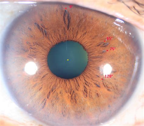 Modern Multidimensional Iridology Partial Atrophy IPB Leaf Lacuna