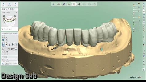 3shape Design Implant Case Osstem Lower Full Arch Youtube