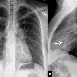 Postero Anterior A And Lateral B Chest Radiographs A Curvilinear