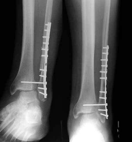 High Ankle Sprain & Syndesmosis Injury - Foot & Ankle - Orthobullets