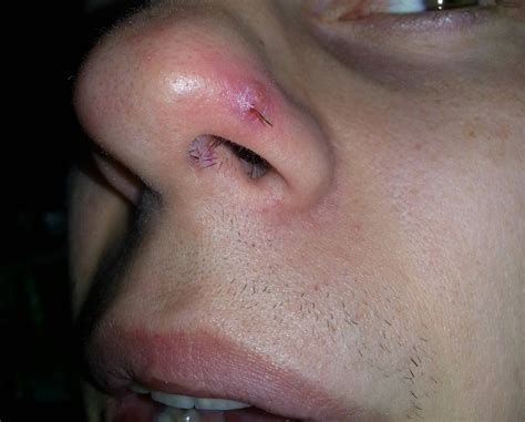 ingrown hair pictures on head - Sherrill Hutchinson