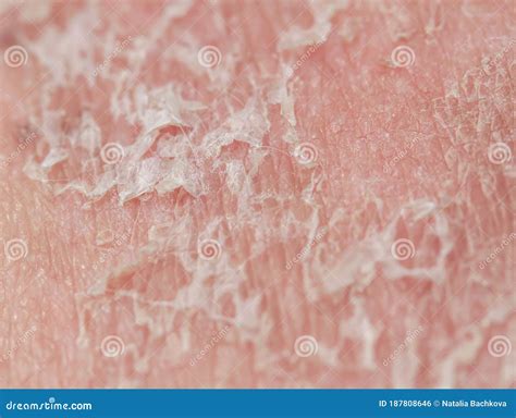 Human Skin Scales