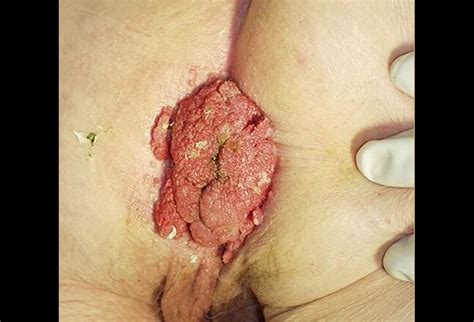 Anal Cancer The Fundamentals