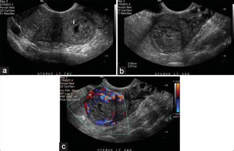 Revisiting Ectopic Pregnancy: A Pictorial Essay - Journal of Clinical