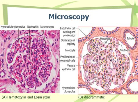 Acute Post Streptococcal Glomerulonephritis Pathogenesis Morphology