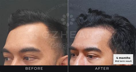 Visit Our Fue Hair Transplant Centre For Affordable Prices Ozhean