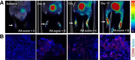 New PET Tracer Detects Inflammatory Arthritis EurekAlert