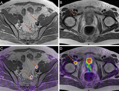 Hybrid Positron Emission Tomographymagnetic Resonance Imaging With