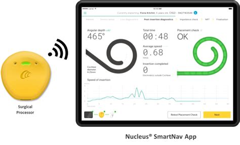history  meaningful innovation cochlear pronews
