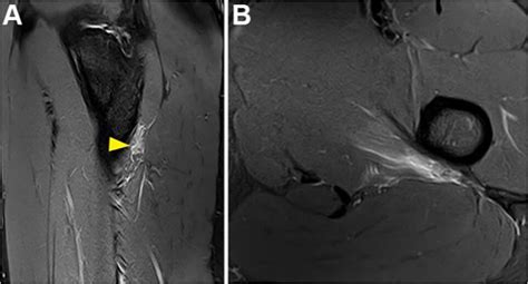 Isolated Adductor Magnus Injuries In Athletes A Case Series Sandra