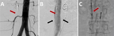 Successful Endovascular Retrieval Of An Inferior Vena Cava Filter