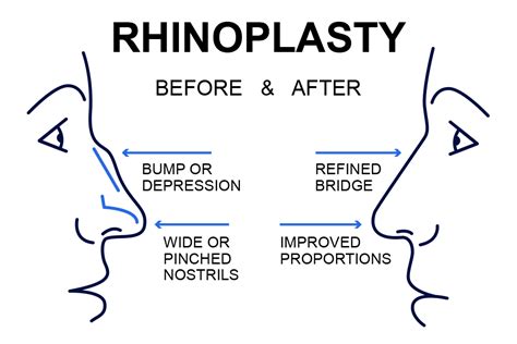 Rhinoplasty Recovery Timeline - Halifax, NS Nasal Surgery Healing