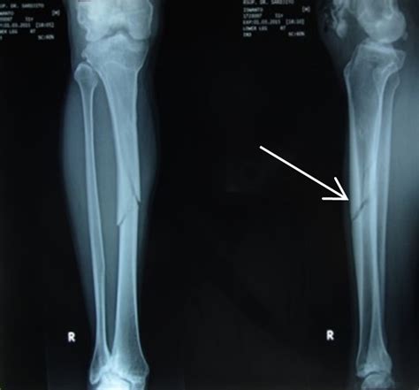 Orthopaedi Knowledges: MANAGEMENT OF LONG BONE FRACTURES