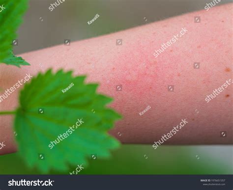 Hand Dermatitis Red Itchy Swollen Skin Stock Photo 1976651357