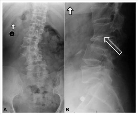 A Anteroposterior Lumbar Radiograph Demonstrating Scoliosis With An