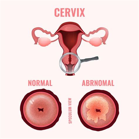 Pap Test Papanicolaou Smear Guide