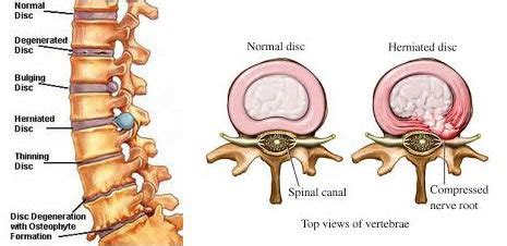 Slipped Disc Surgery 101 - GaiaGuides.com