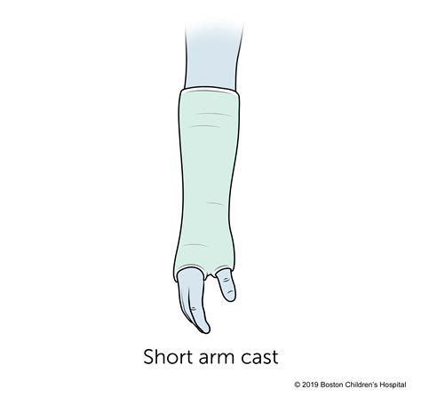 Types Of Casts Boston Childrens Hospital