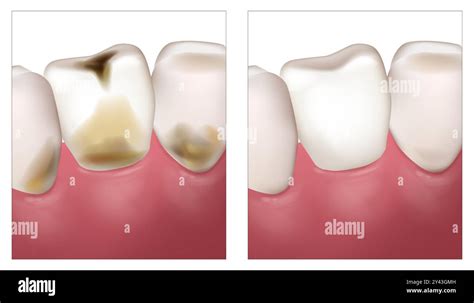 dental cavities dental caries cavities caries tooth decay