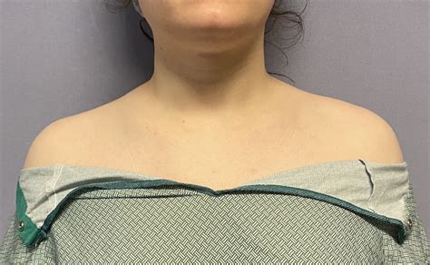 Plastic Surgery Case Study - Shoulder Narrowing Surgery in Highly ...