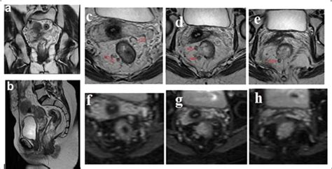 A H Mri Study For Years Old Female With Pathologically Proven Cancer