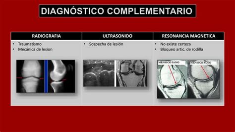 Lesiones Meniscales De Rodilla Y Su Evaluacion En La Pr Ctica Cl Nica Ppt