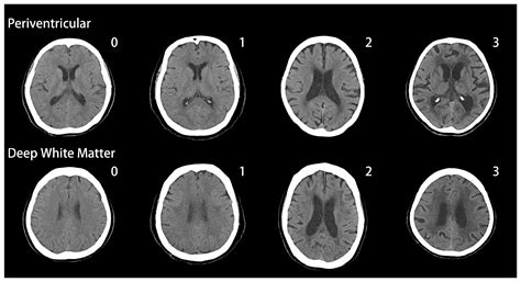 White Matter Changes in Patients with Alzheimer’s Disease and