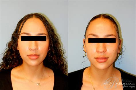 Dermal Fillers Before And After Pictures Case Las Vegas And