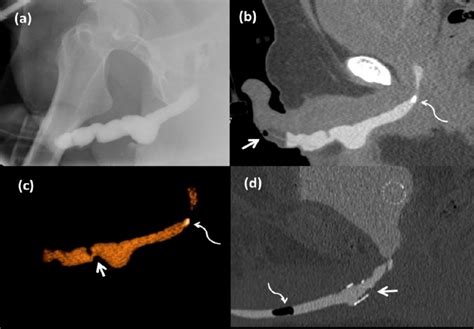 Urethral Anomalies Detected Only By Ct Retrograde Urethrography A Download Scientific