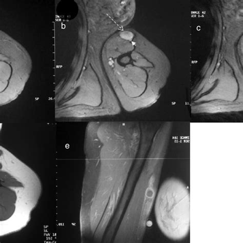 Gradient Echo Axial Mri From May 2004 Above A At The Level Of B