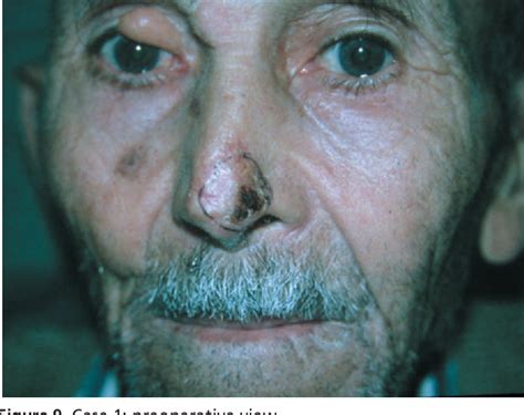 figure   prefabricated nasolabial flap  reconstruction  full