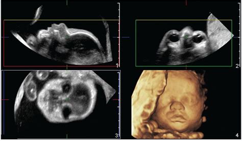 Three Dimensional Ultrasonography Radiology Key