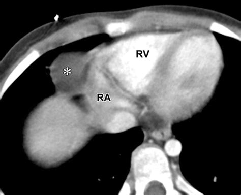 Pediatric Cardiac Tumors Clinical And Imaging Features Radiographics