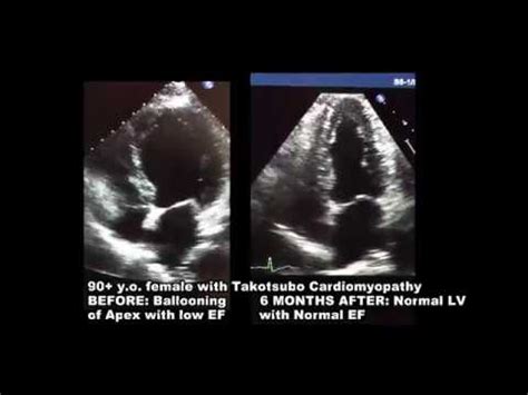 D Echocardiogram Takotsubo Cardiomyopathy Youtube