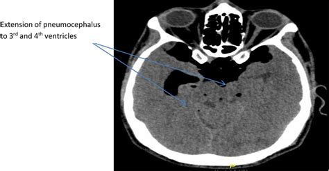 Extension Of Pneumocephalus To Rd And Th Ventricles Case