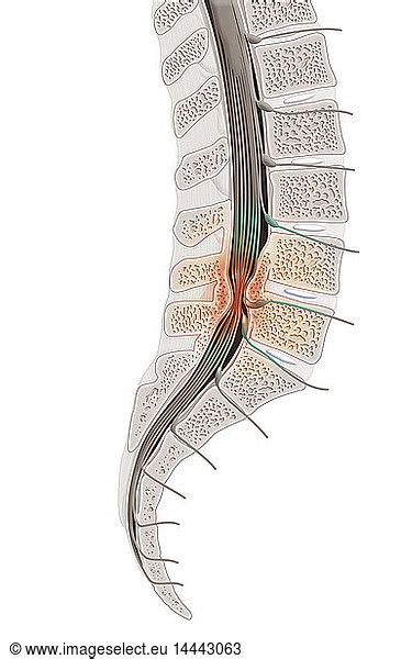 Illustration Of Spinal Stenosis In L4 And L5 Spinal Stenosis Is A