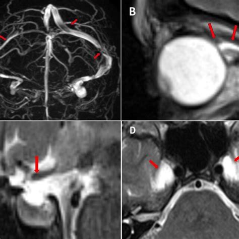 Mr Venography Showing A A Transverse And Sigmoid Sinus Hypoplasia On