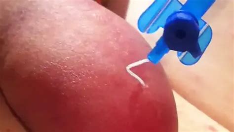 Free Foreskin Inflation Gay Porn Videos Xhamster