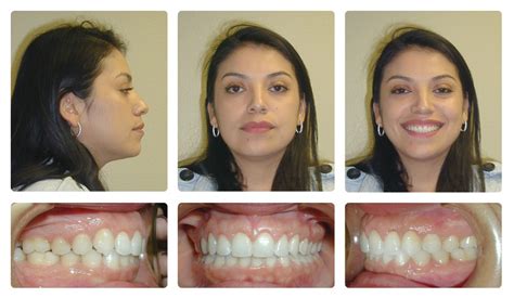 Invisalign Before And After Overjet