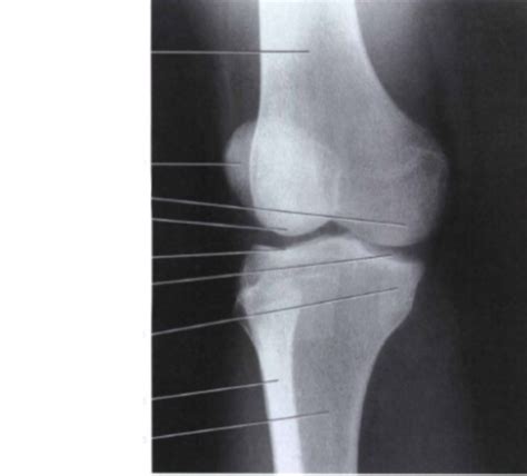 Lateral Oblique Knee Labeling Diagram Quizlet