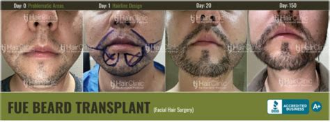 Beard Transplant In Mexico Tj Hair Clinic