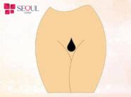 15 mẫu triệt lông bikini tạo hình nữ giới đẹp ấn tượng