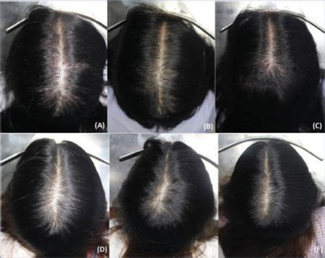 Redensyl, Capixyl, & Procapil (RCP) For Natural Hair Regrowth?