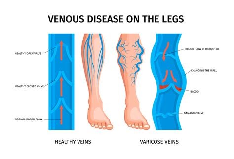 Varicose Vein Ulcer Treatment | Effective Care & Healing Options