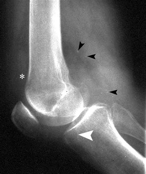 Imaging of Synovial Chondromatosis with Radiologic-Pathologic ...