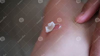 Blisters Skin on the Soles of the Feet Stock Image - Image of blister
