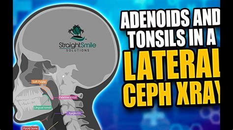 Evaluating Airway Adenoids And Tonsils In A Lateral Ceph Xray Youtube